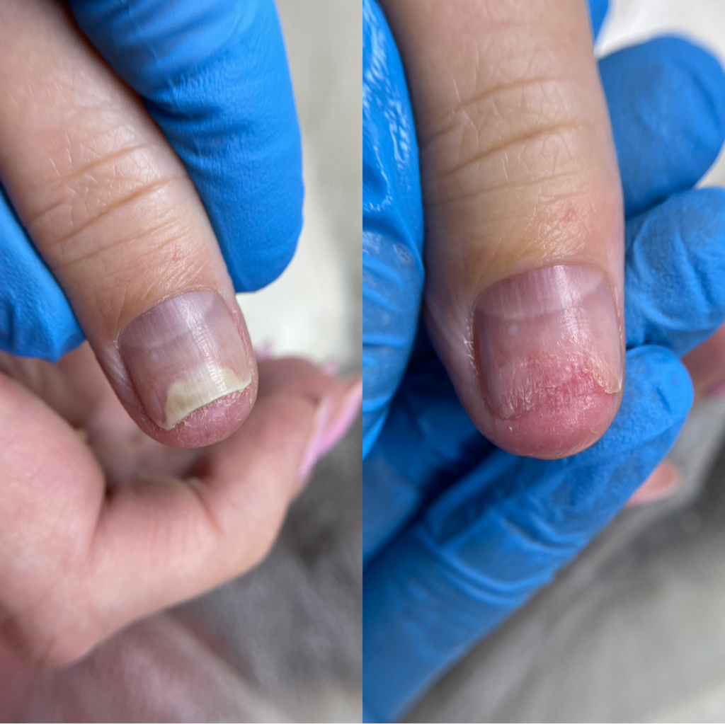 Обработка видоизмененного ногтя на руке