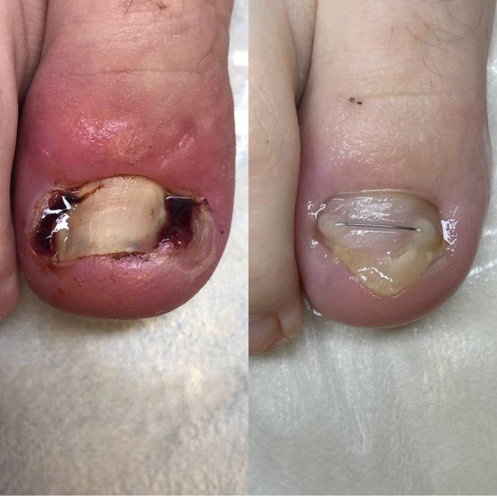 Обработка вросшего ногтя (lll стадия)  Покраснение, отёк, гной, гипергрануляция