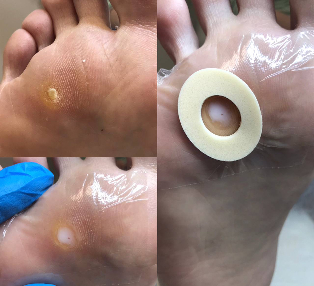 Обработка мозоли + разгрузка