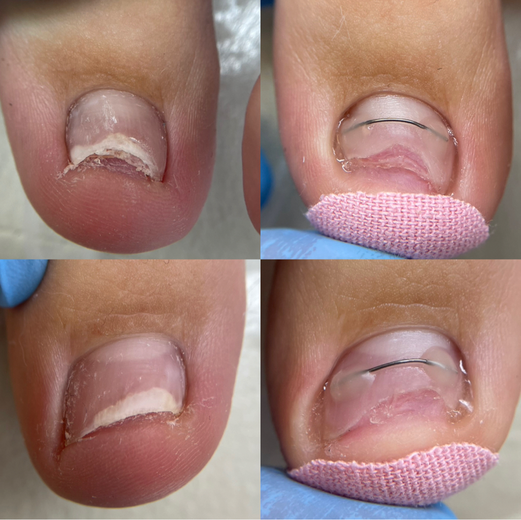 Вторичная установка корректирующей системы