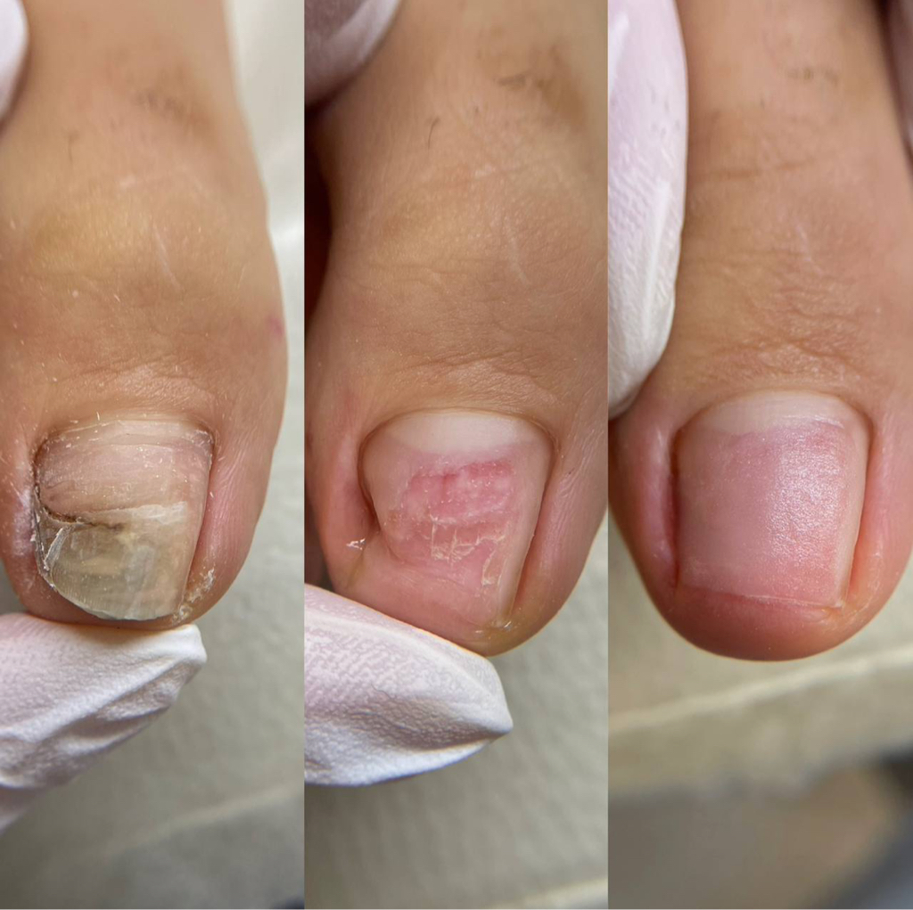 Протезирование ногтевой пластины