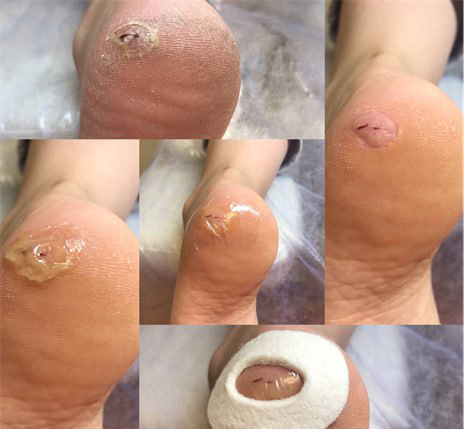 Обработка трещин + разгрузка