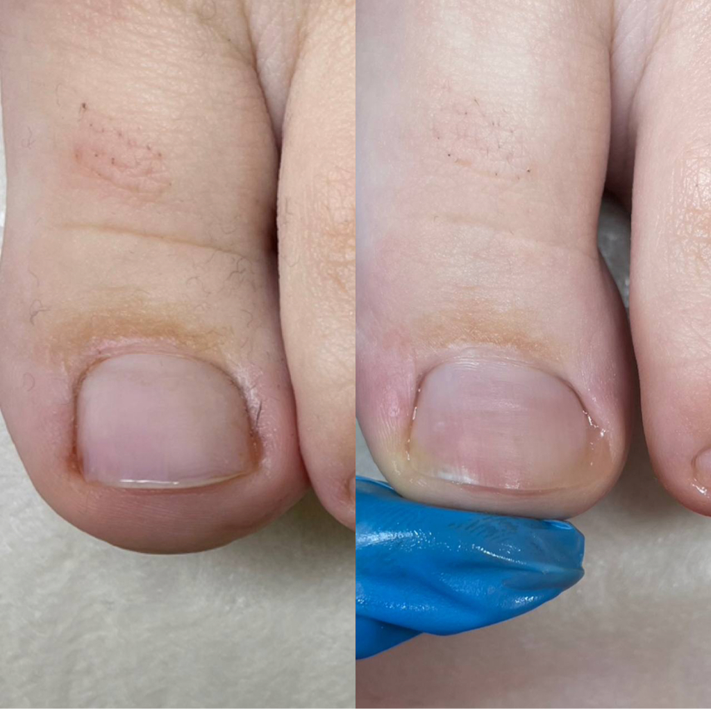 Установка тампонады