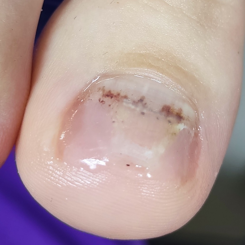 Протезирование ногтевых пластин