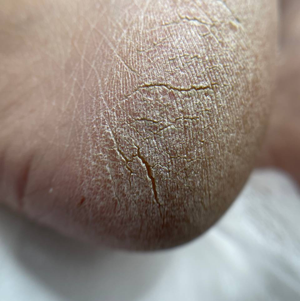 Сложный случай в педикюре