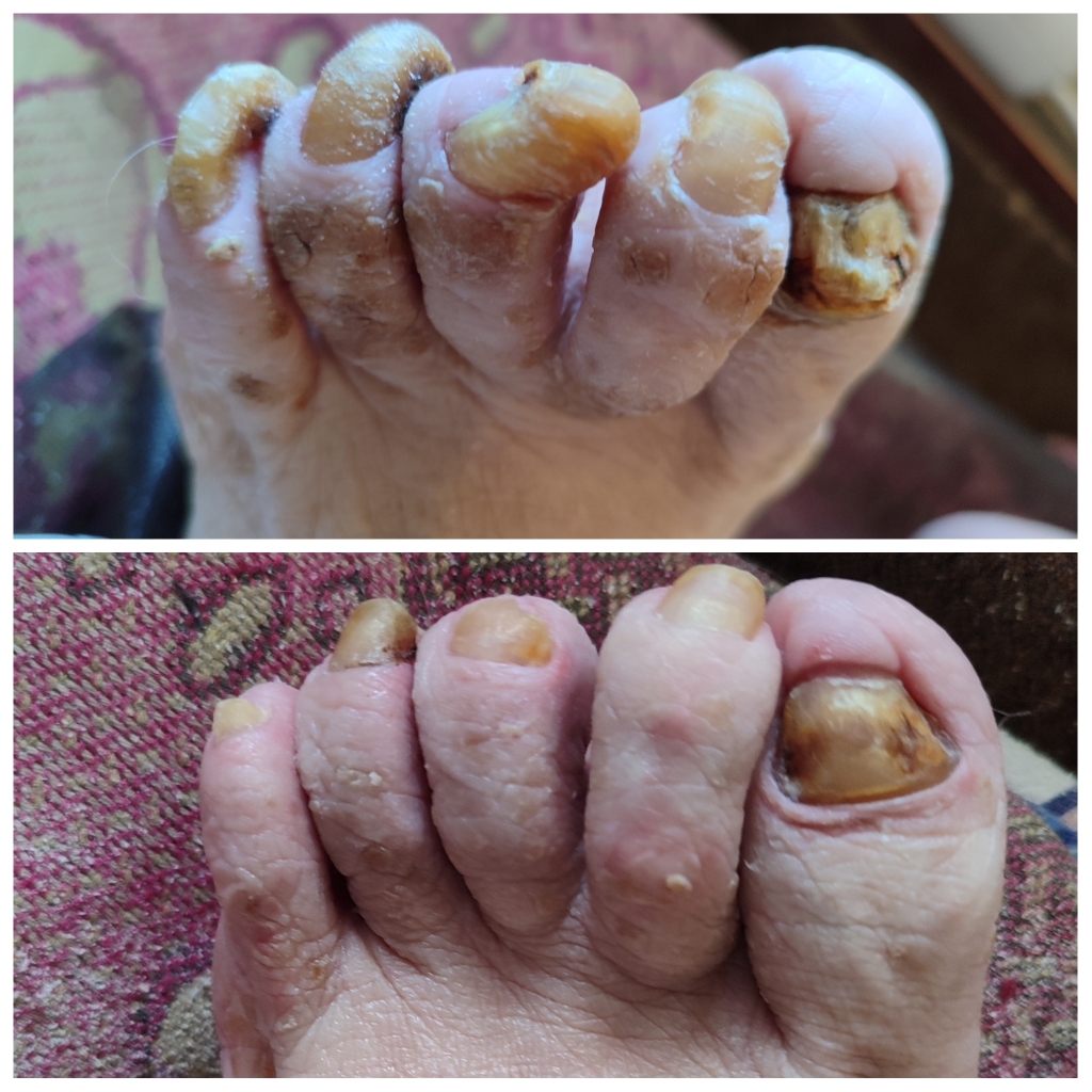 Педикюр при обработке сложных ногтей и стопы