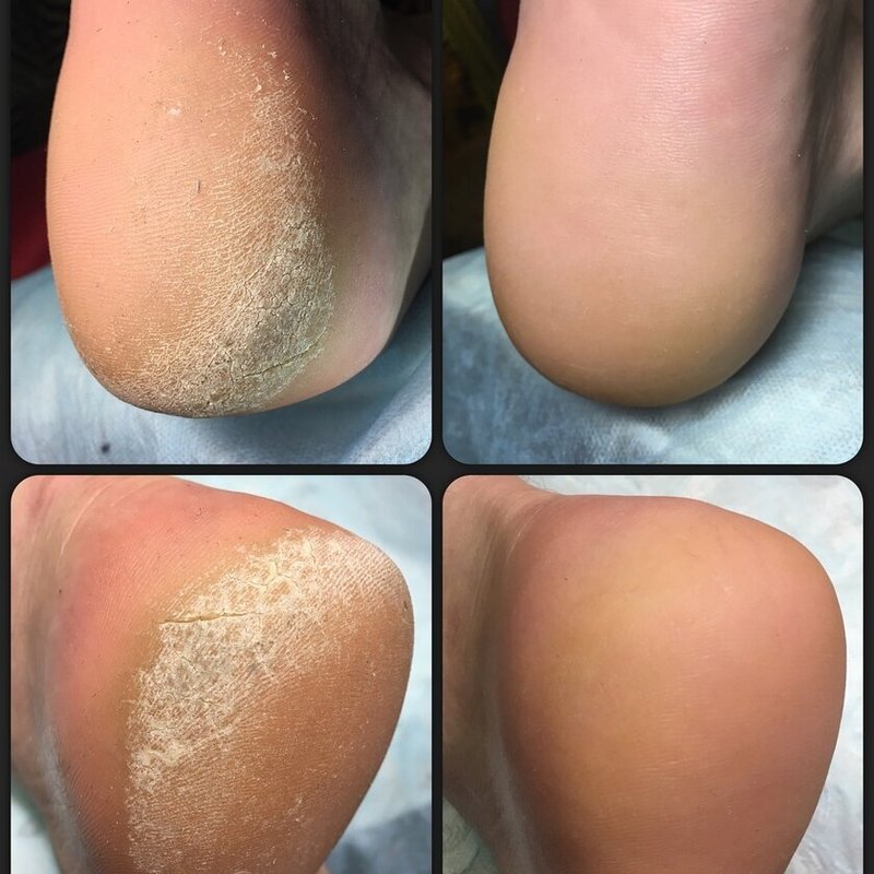 Педикюр при обработке сложной стопы