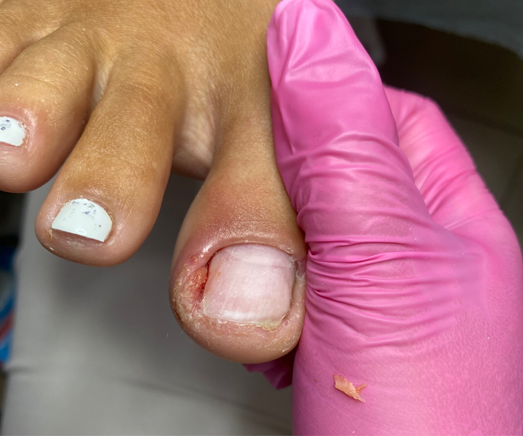 Удаление вросшего ногтя 2 степень