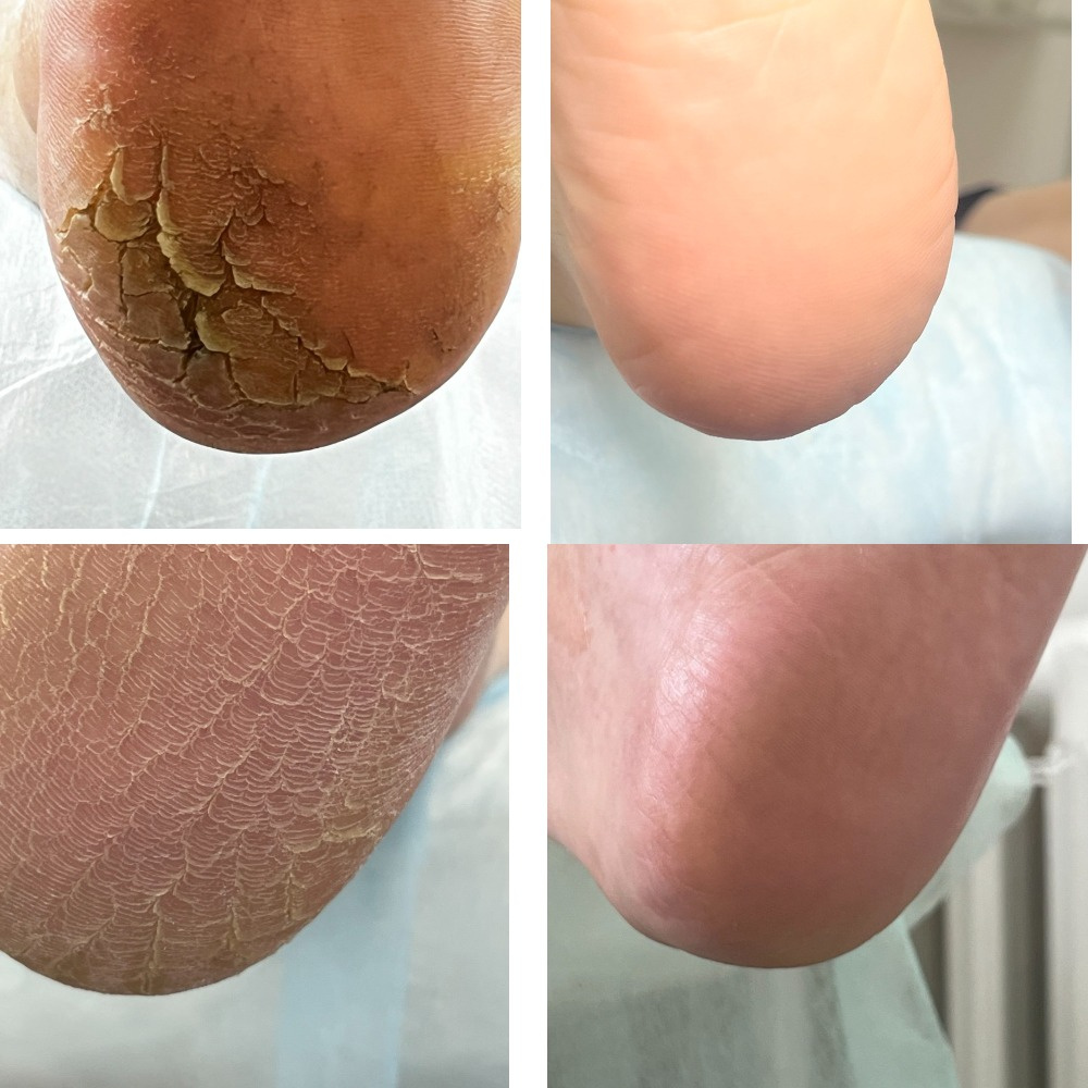 Подологическая обработка стопы и ногтей (стопы с трещинами, деформированными ногтями)