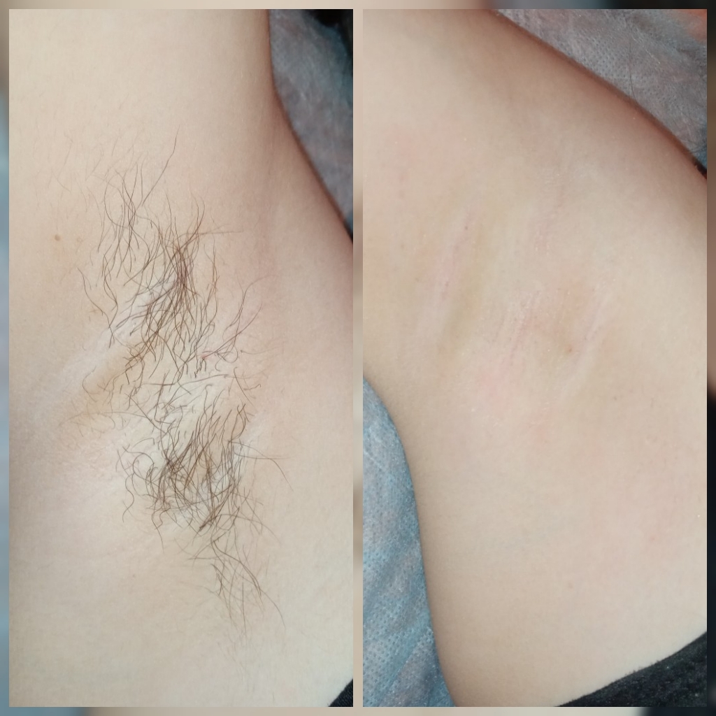 Подмышечные впадины