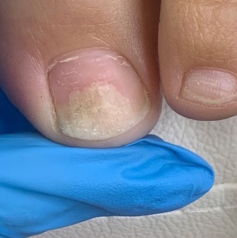 Зачистка онихолизиса 1 ед.