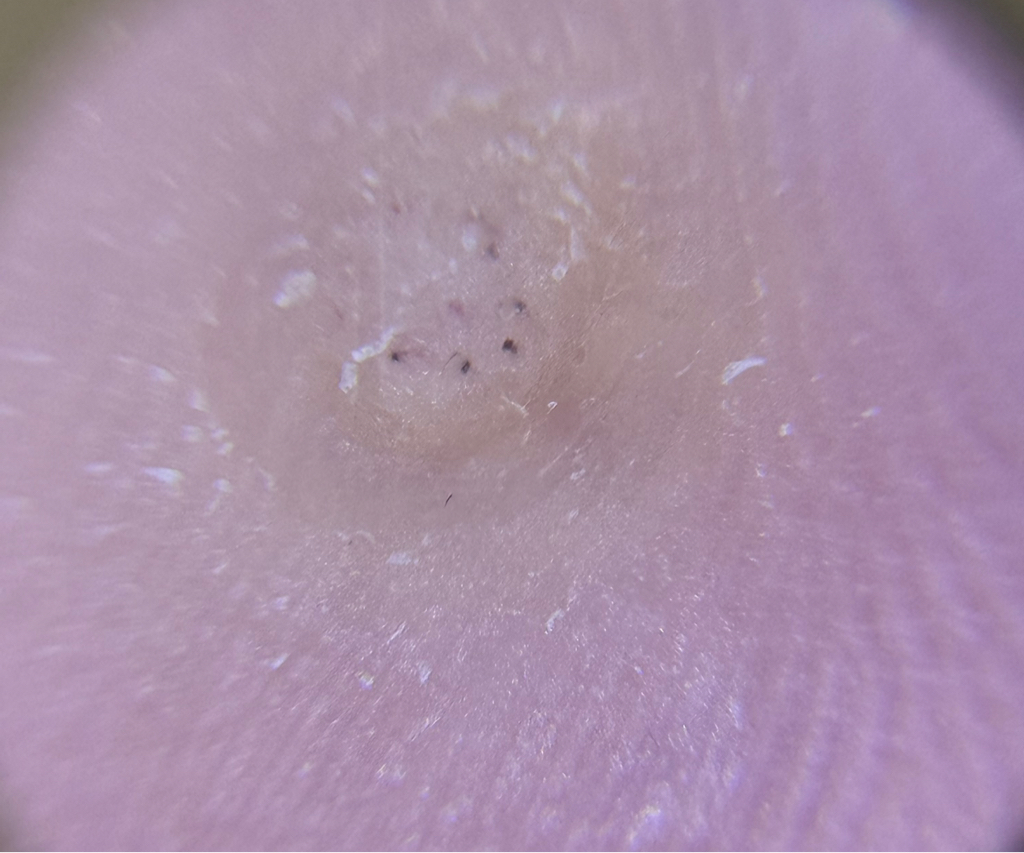 Обработка ВПЧ (бородавка)