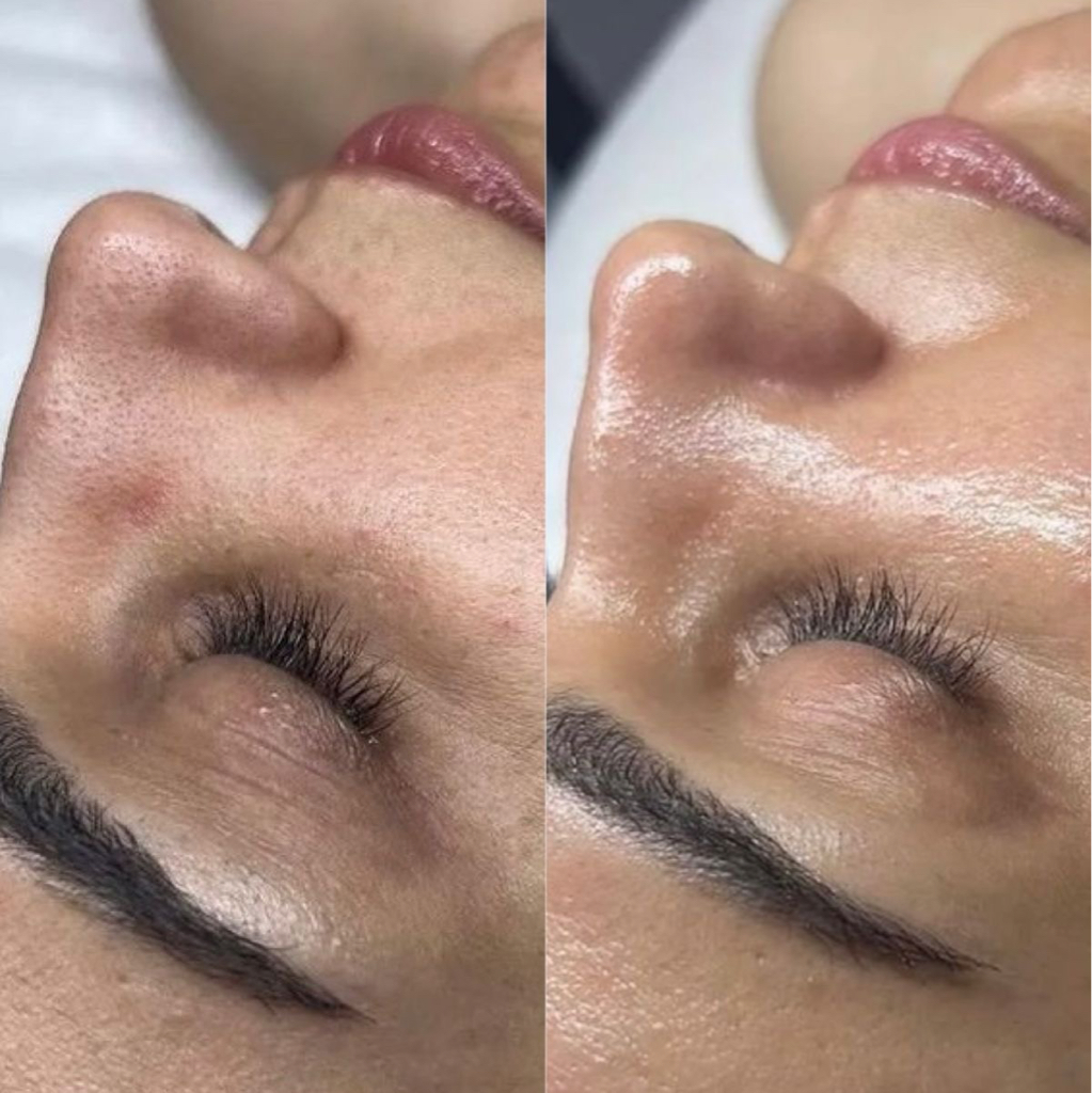 Комбинированная чистка лица