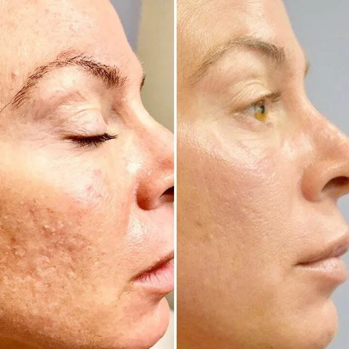 Пилинг Джесснера