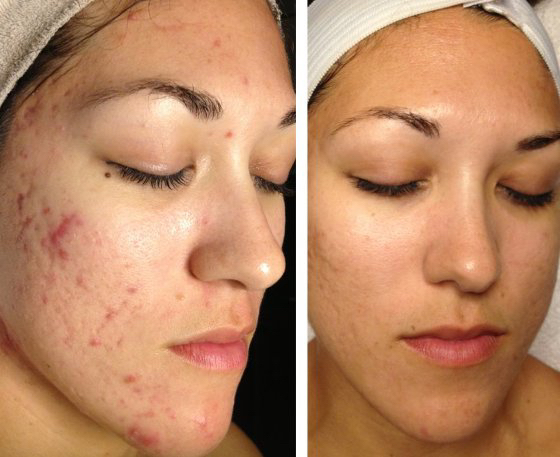 Салициловый пилинг