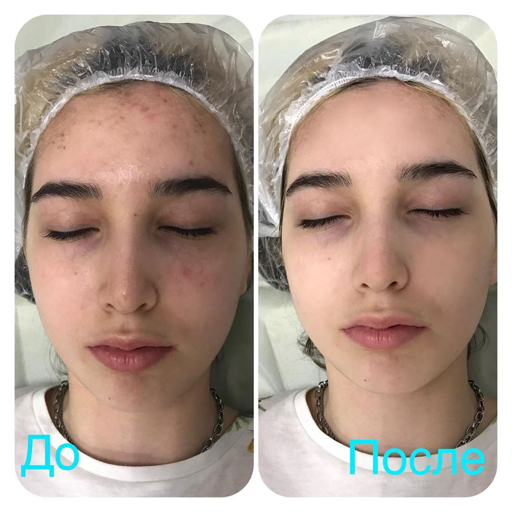 Молочный пилинг