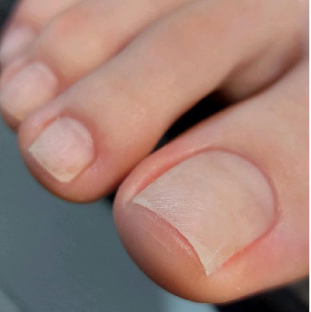 Вросший ноготь/Зачистка онихолизиса