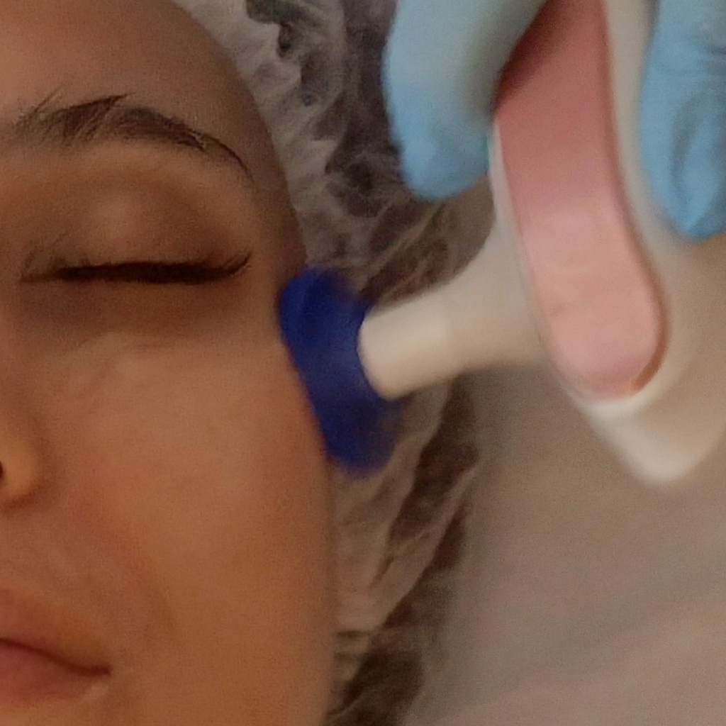 Абонемент на 5 сеансов Индиба по лицу