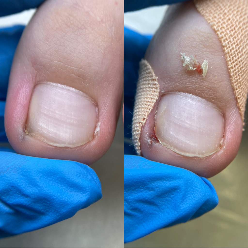 Обработка вросшего ногтя (l стадия)  Покраснение и отёк