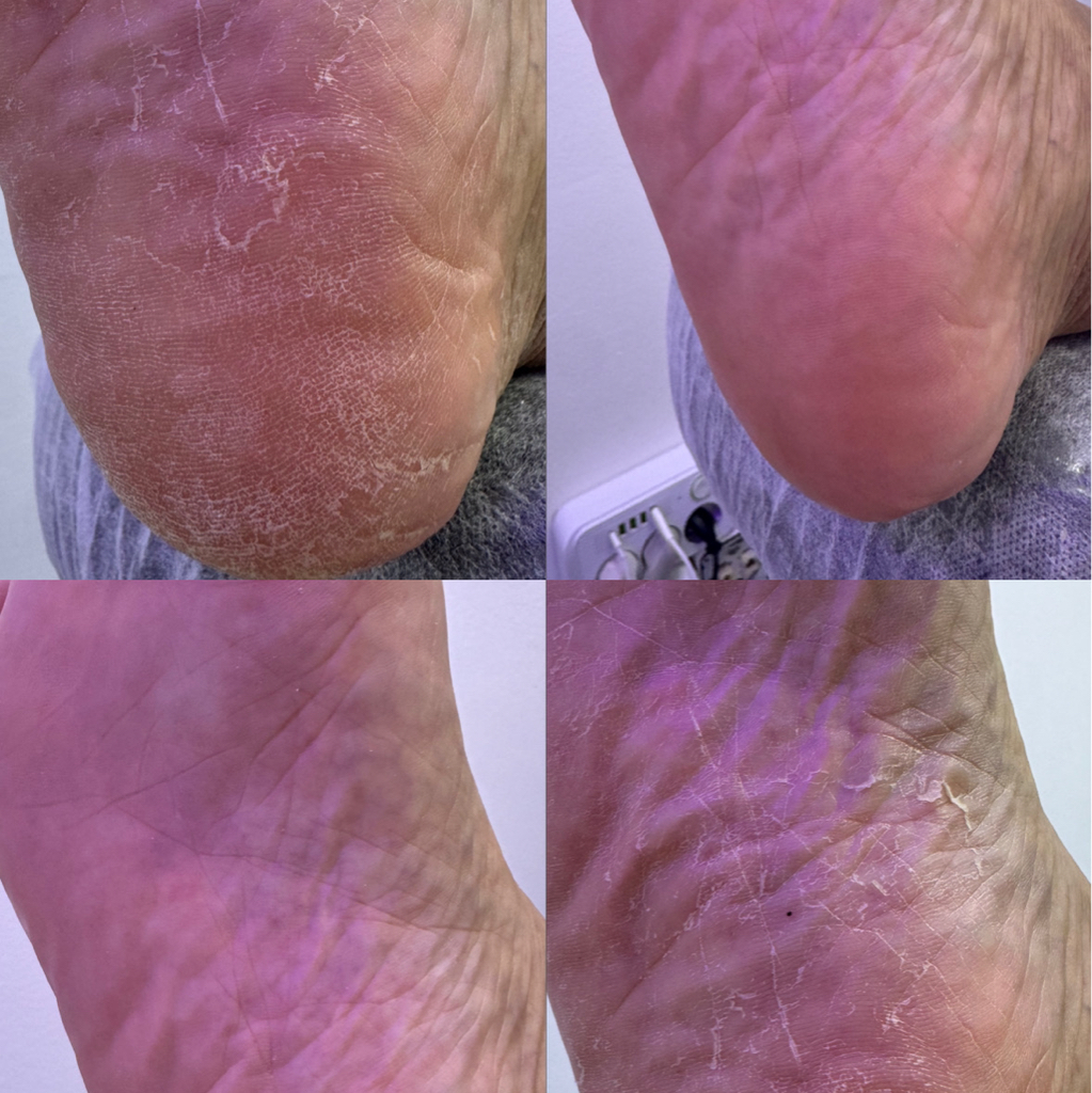 Обработка стоп