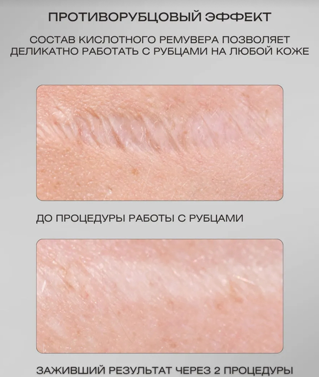 Камуфляж рубцов, шрамов, растяжек, витилиго