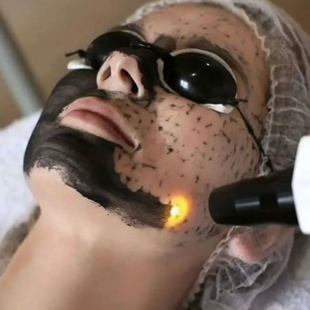 Карбоновый пилинг