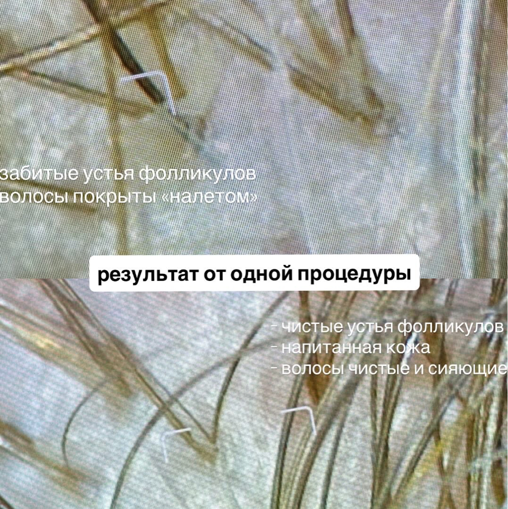 Пилинг кожи головы