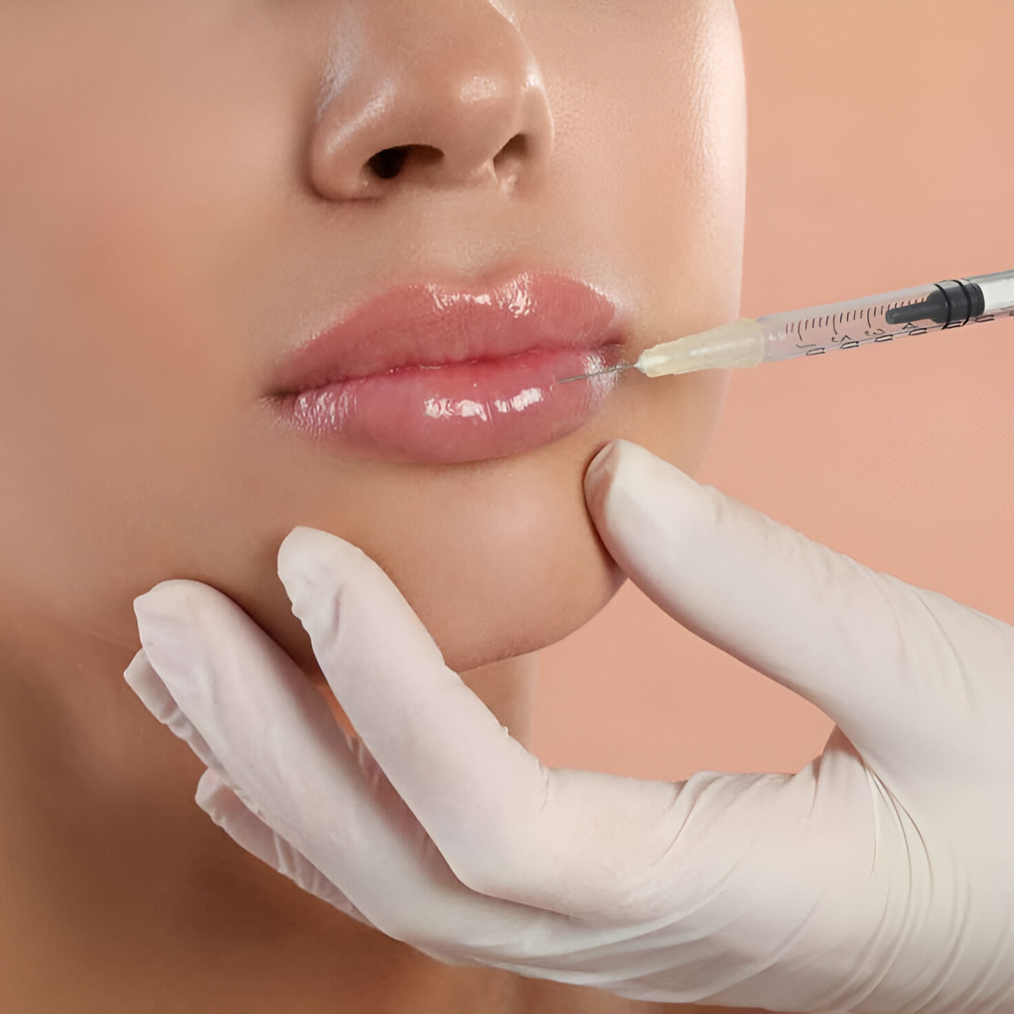 Контурная пластика лица филлером ART FILLER Lips ( 1,0 мл)
