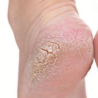 Педикюр 2 категория  обработка стоп и ногтей высокой сложности (онихолизис, утолщение НП, мозоли, гиперкератоз, трещины,онихогрифоз)