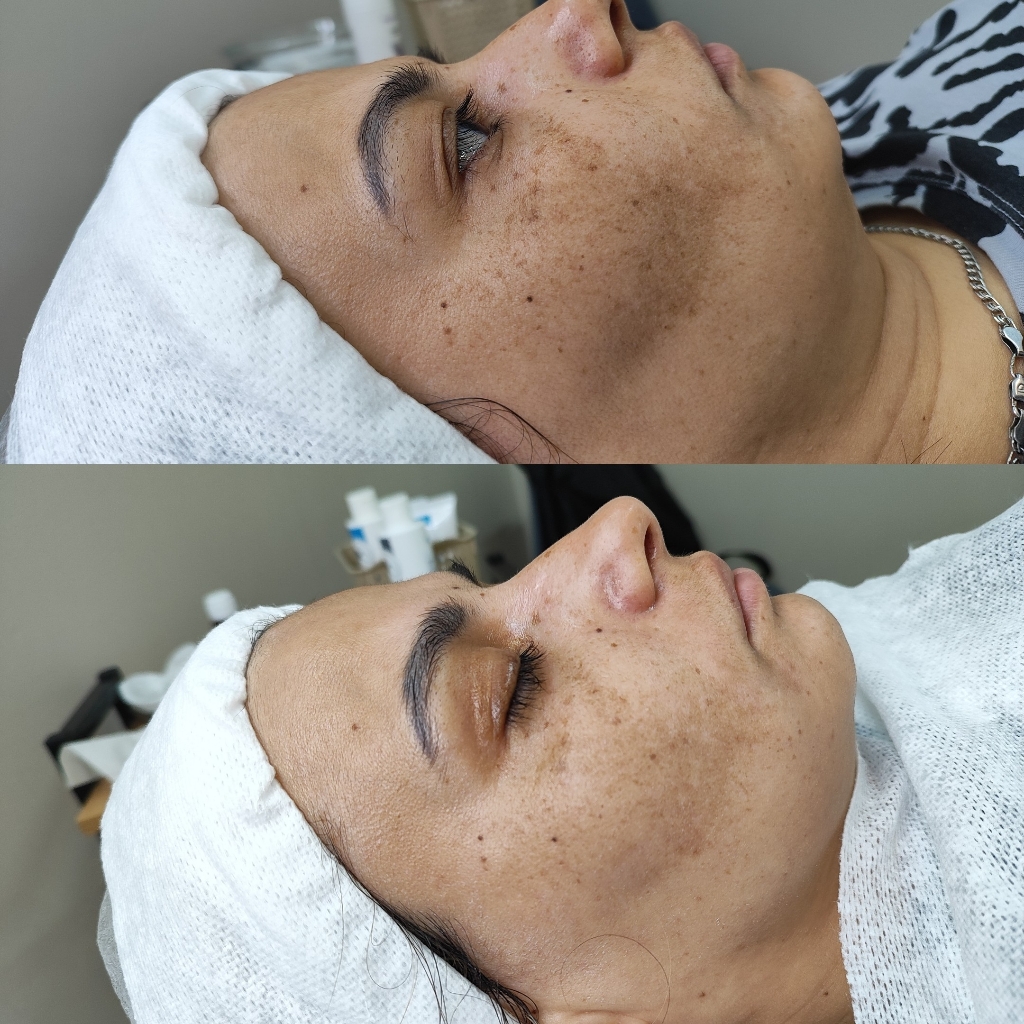 Отбеливание лица Dbright