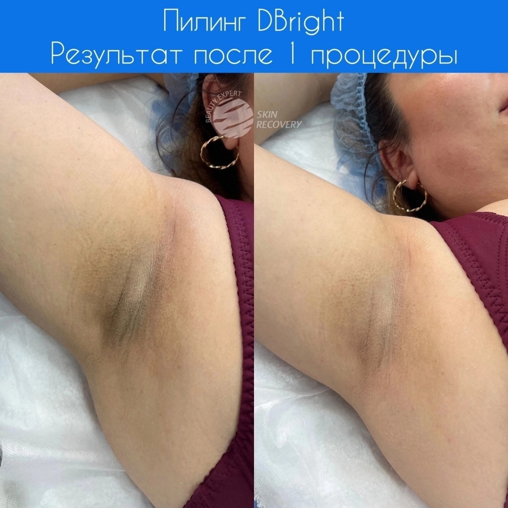 Отбеливание подмышечных впадин