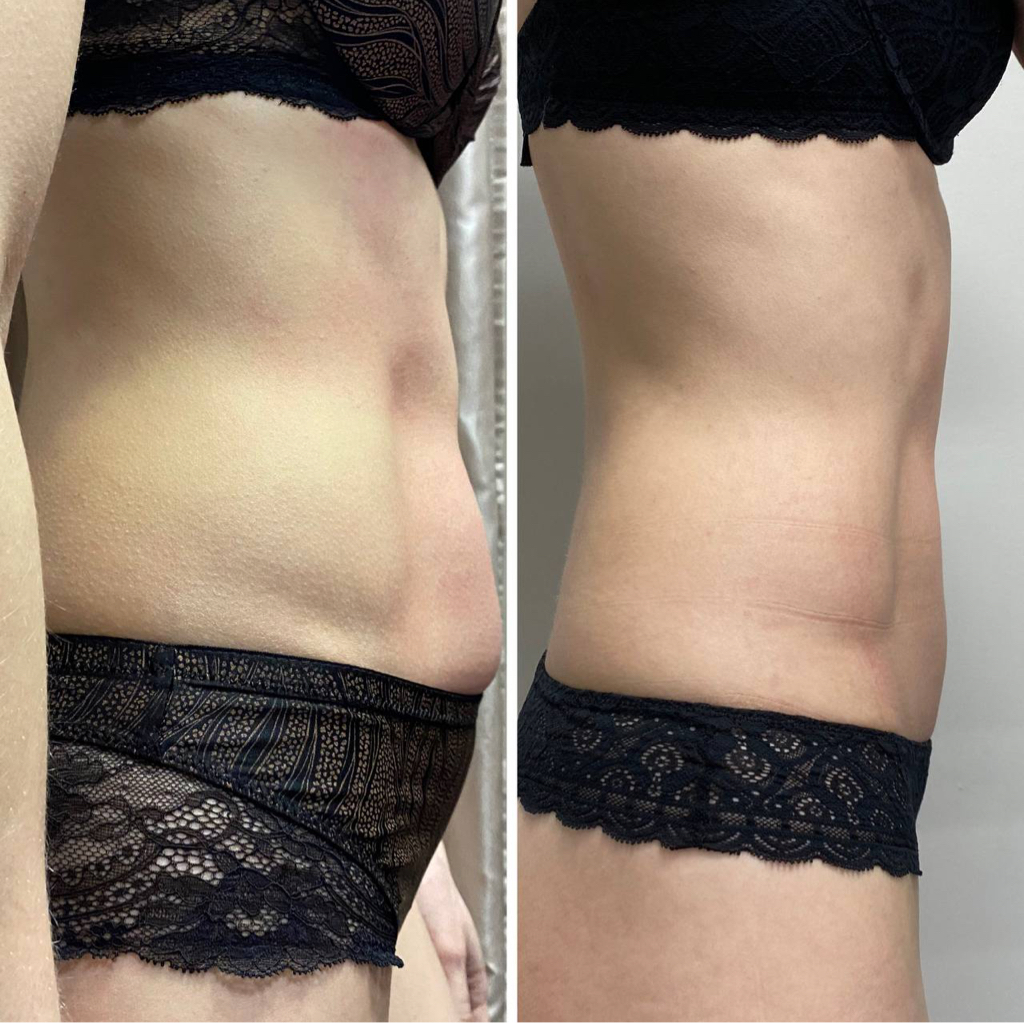 Программа «Меняю тело» 10 сеансов LPG массажа + 10 сеансов обертывание в термоодеяле.