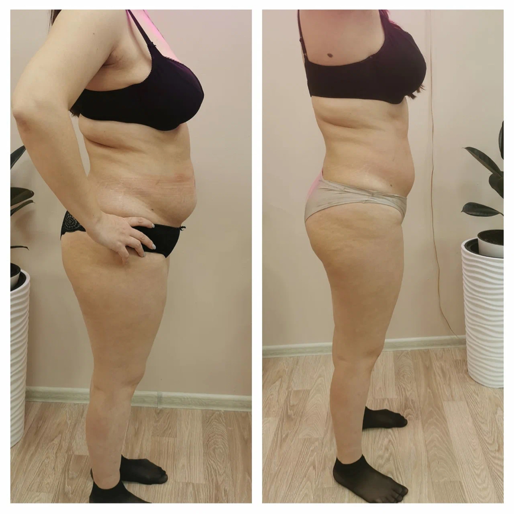 LPG тело (Абонемент 5 процедур)