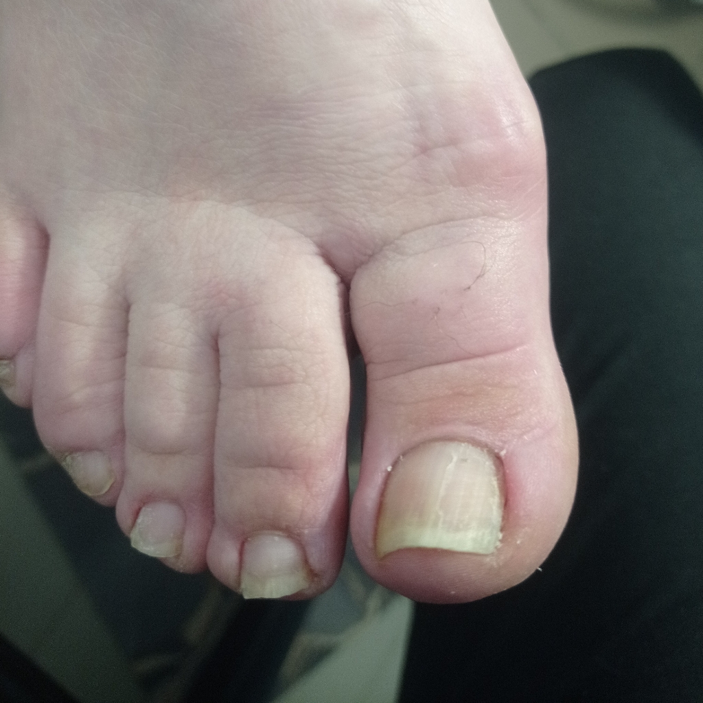 Педикюр. Подообработка всех ногтей + зачистка 1-2 поражённых/видоизмененных ногтей.