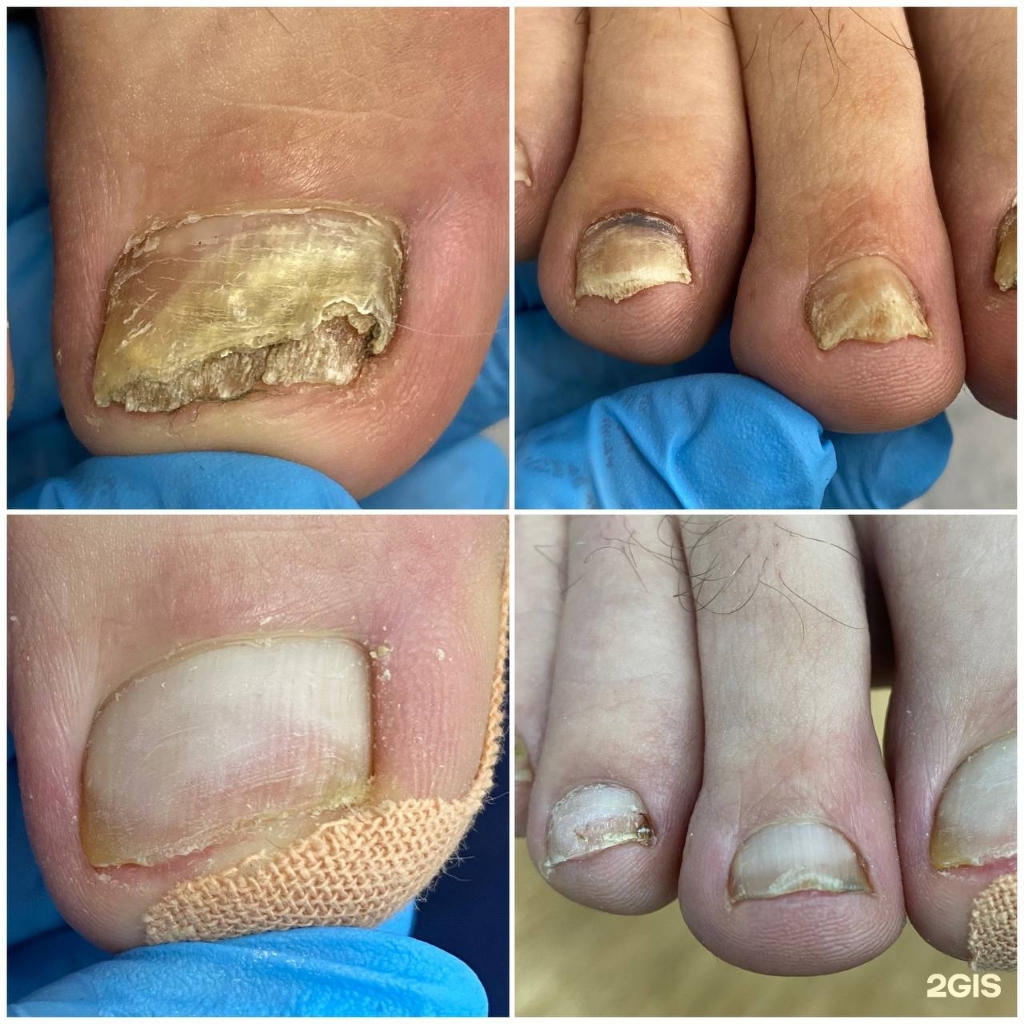 Зачистка грибкового поражения (простые) или повтор не позднее 1 месяца