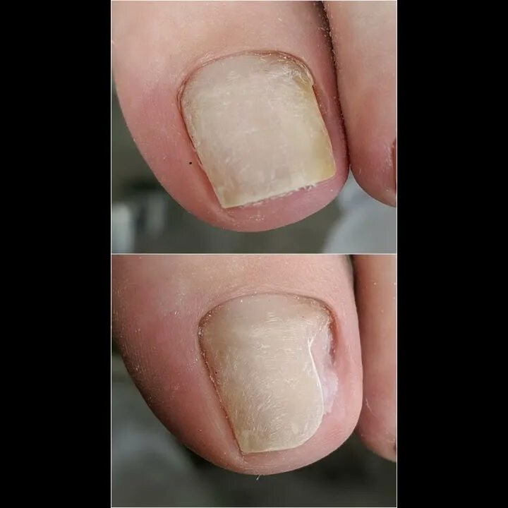 Зачистка онихолизиса 1 ноготь