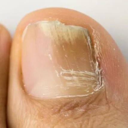 Зачистка грибкового поражения 1 ноготь