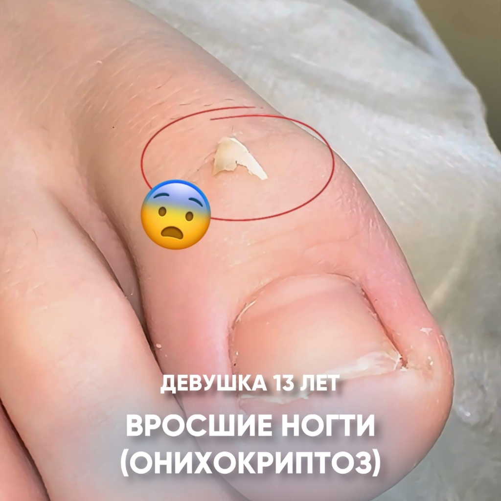 Обработка вросшего ногтя повторная
