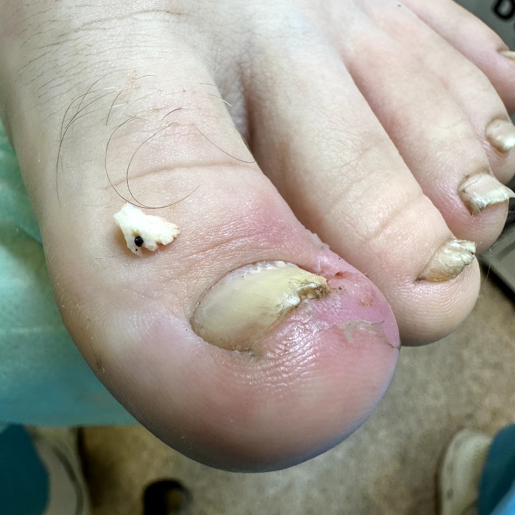 Обработка вросшего ногтя