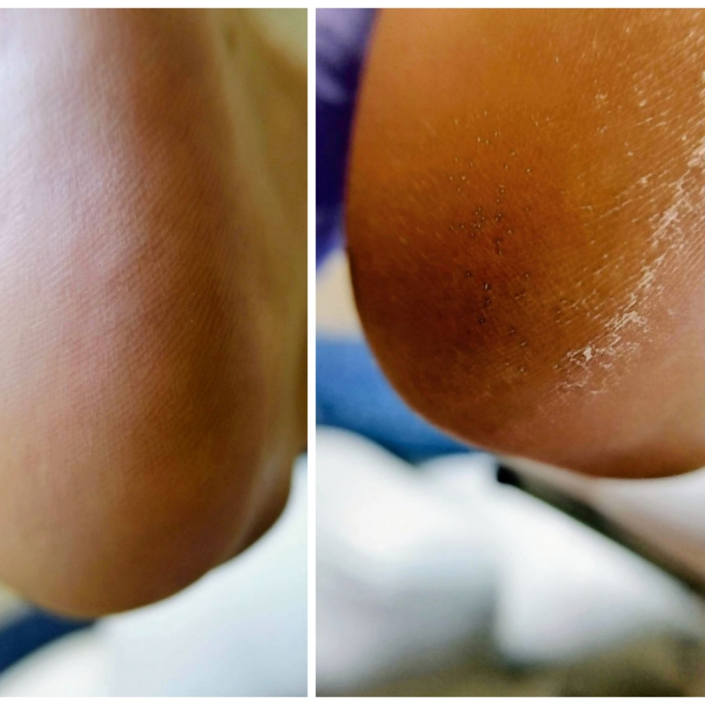 Обработка стопы Kart