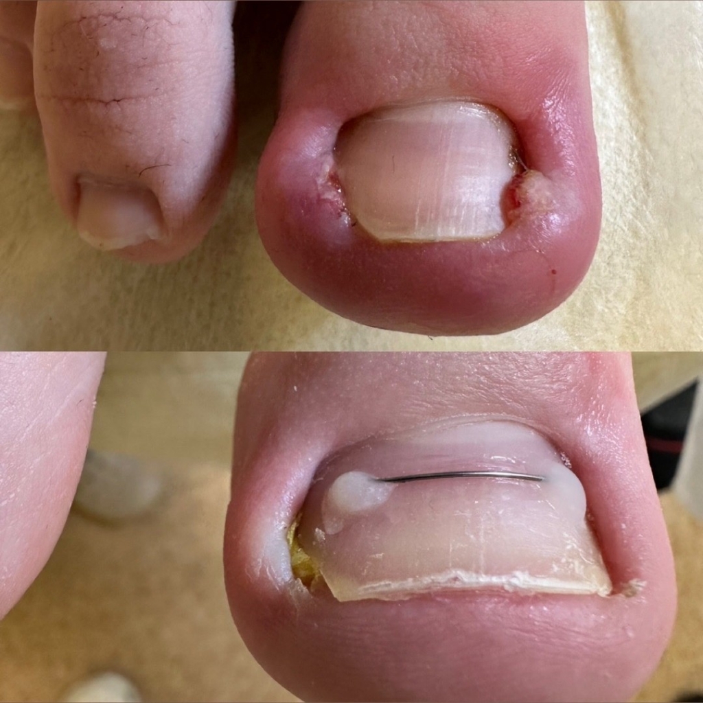 Коррекция титановой нити или маленький ноготь