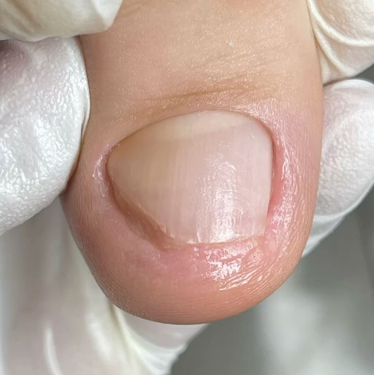 Зачистка онихолизиса на руках/ногах (ноготь)