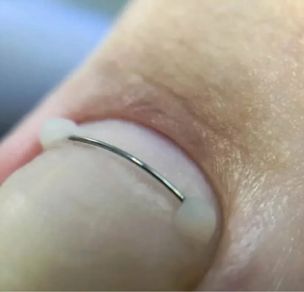 Коррекция вросшего 1 ногтя «Титановая нить»