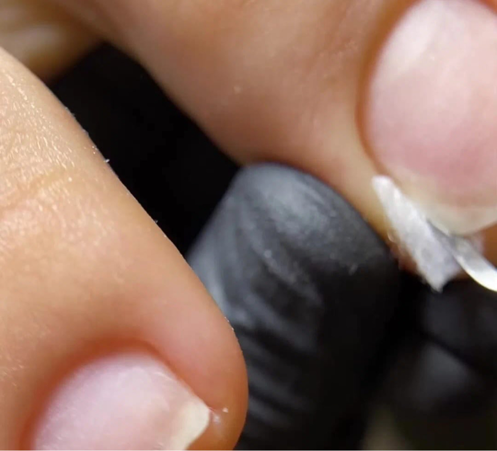 Установка тампонады (кополин)