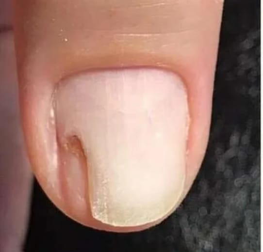 Зачистка онихолизиса