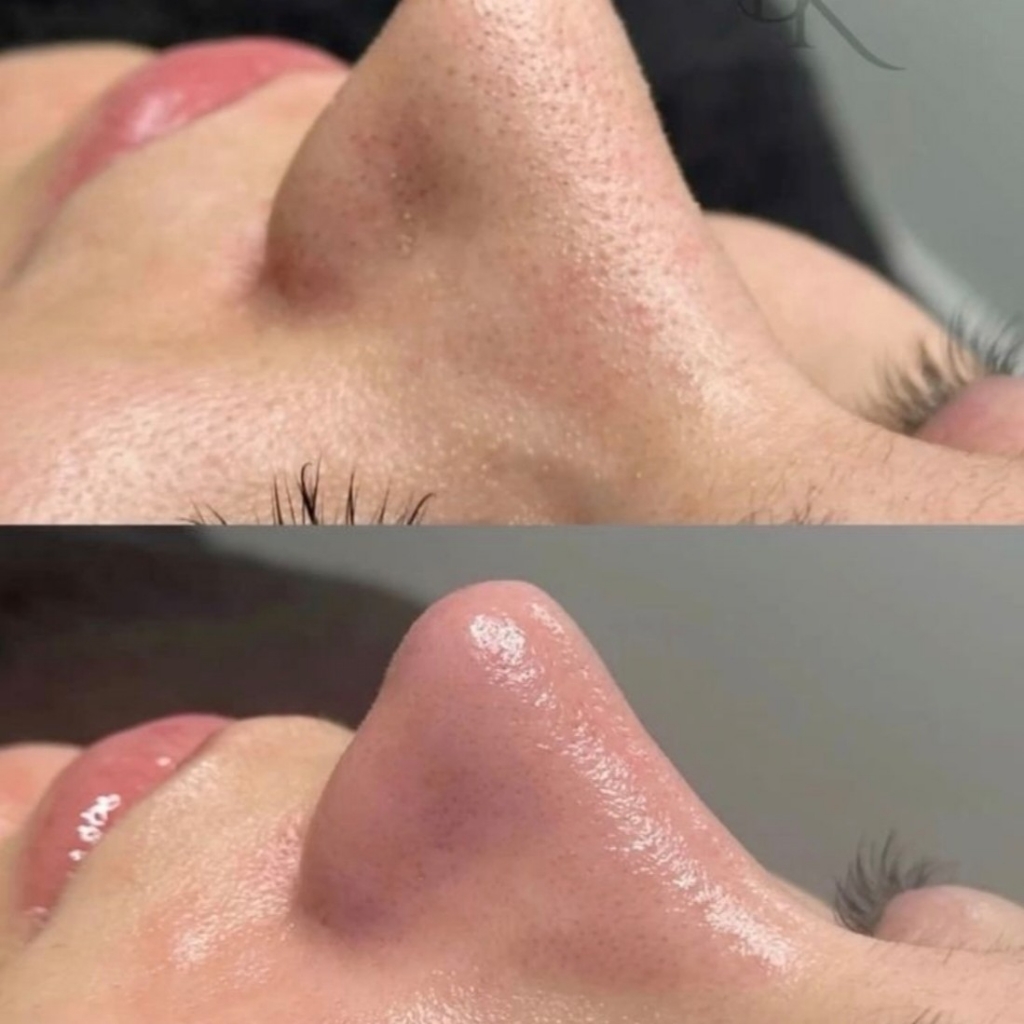 Комбинированная чистка лица