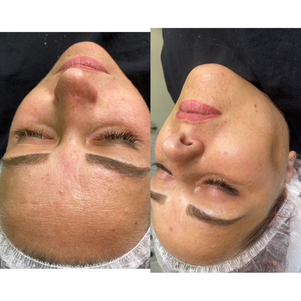 Фарфоровая кукла(чистка + массаж ГК)