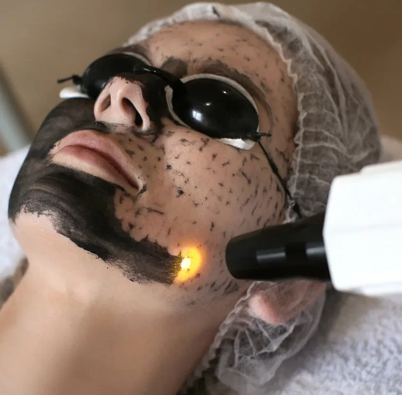 Карбоновый пилинг