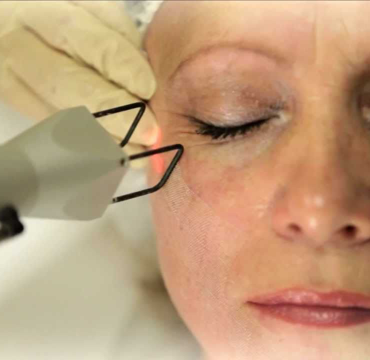 Лазерная шлифовка (ГЛАЗА - Н/ВЕКО + В/ВЕКО + ГУСИНЫЕ ЛАПКИ)