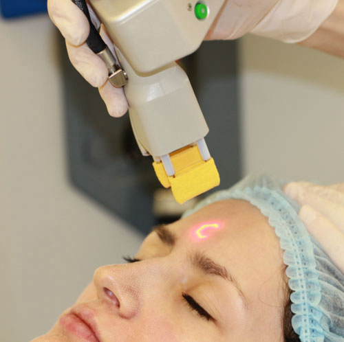 Лазерная шлифовка (лоб)